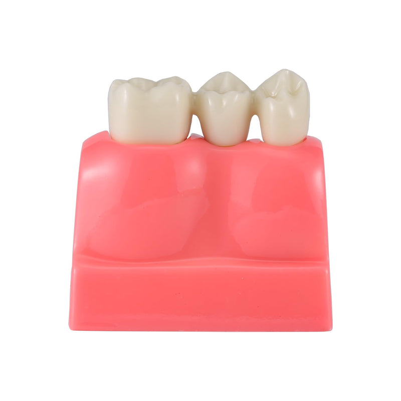 4X Dental Implant Demo Model | removable crown, bridge, tooth root, gold-colored base, and blue implant,For Teaching