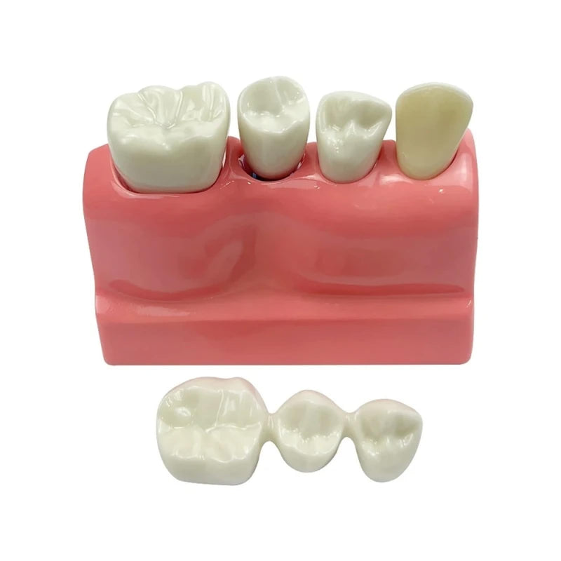 4 Times Dental Implant Model with Removable Crown Bridge Dental Veneers Porcelain Teeth for Stutent Study and Teaching Demonstration