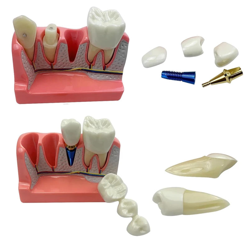 4 Times Dental Implant Model with Removable Crown Bridge Dental Veneers Porcelain Teeth for Stutent Study and Teaching Demonstration