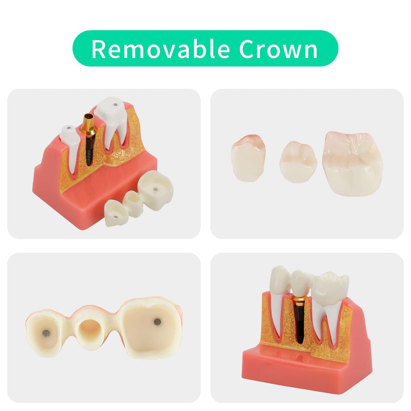 Annhua 4 Times Dental Implant Teeth Model Analysis Crown Bridge Demonstration Model, Dental Teeth Crown Roots Removable for Education, Patients Communication, Learning and Lab