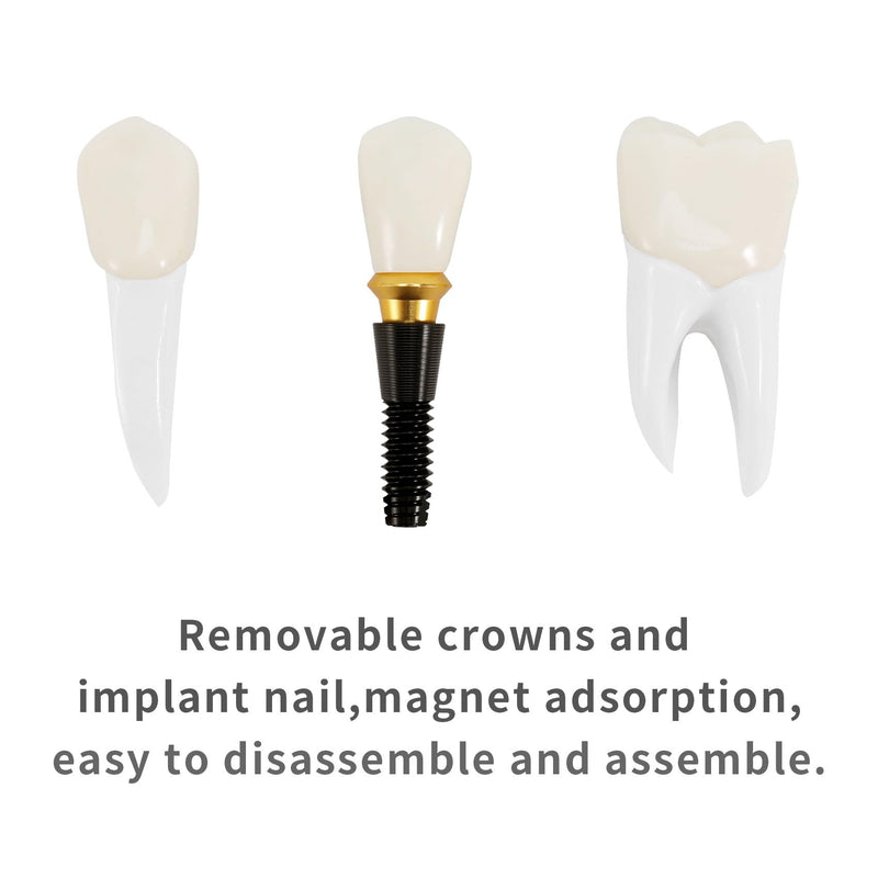 Annhua 4 Times Dental Implant Teeth Model Analysis Crown Bridge Demonstration Model, Dental Teeth Crown Roots Removable for Education, Patients Communication, Learning and Lab