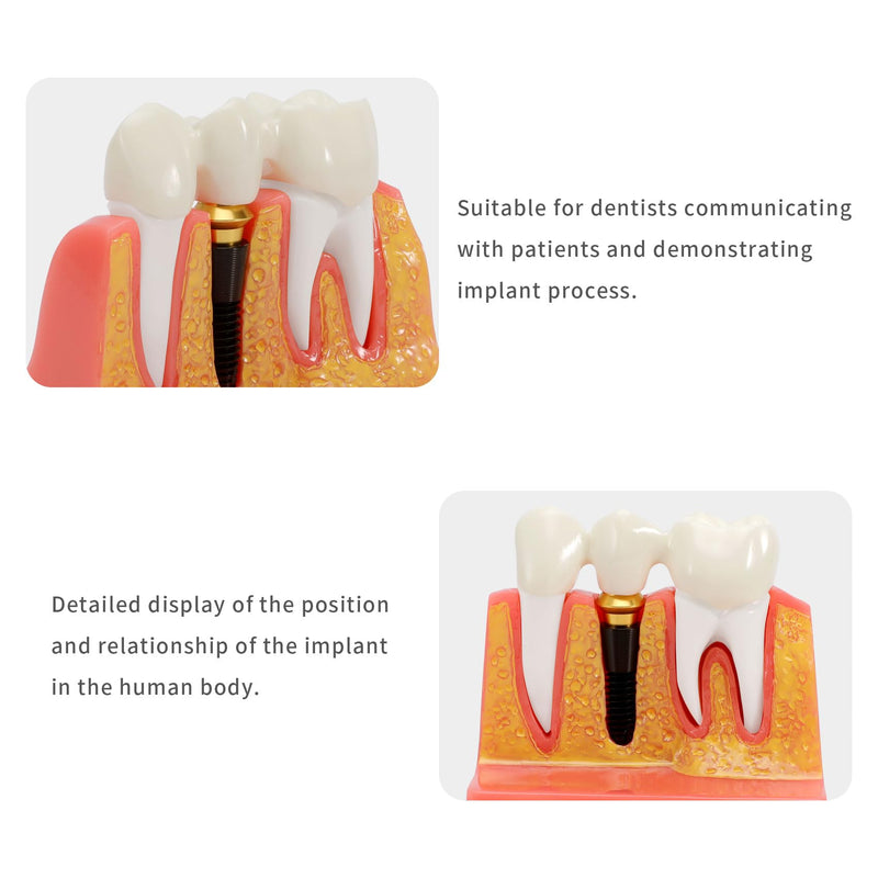 Annhua 4 Times Dental Implant Teeth Model Analysis Crown Bridge Demonstration Model, Dental Teeth Crown Roots Removable for Education, Patients Communication, Learning and Lab