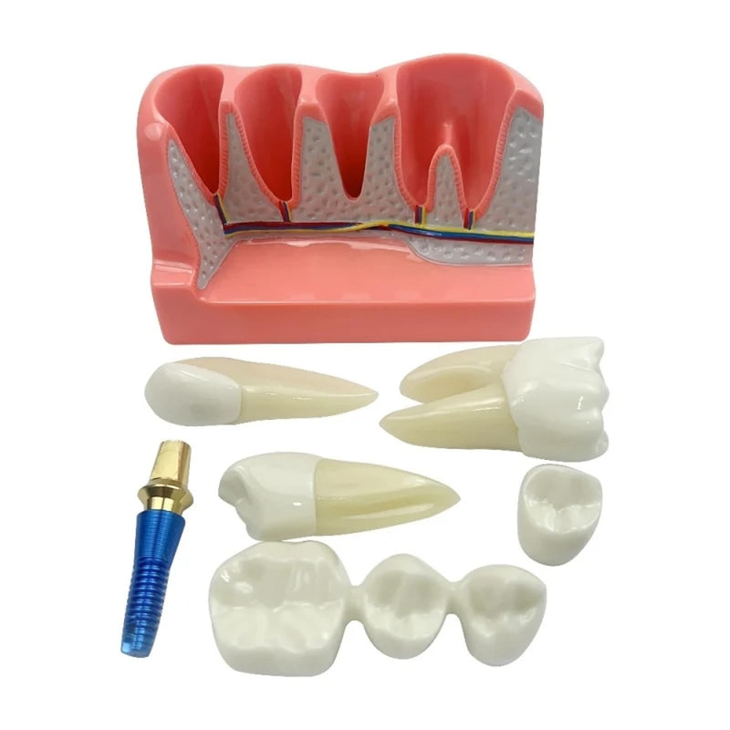 4 Times Dental Implant Model with Removable Crown Bridge Dental Veneers Porcelain Teeth for Stutent Study and Teaching Demonstration