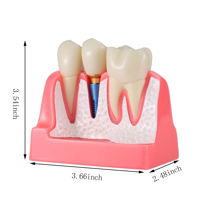 4X Dental Implant Demo Model | removable crown, bridge, tooth root, gold-colored base, and blue implant,For Teaching