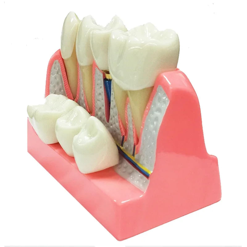 4 Times Dental Implant Model with Removable Crown Bridge Dental Veneers Porcelain Teeth for Stutent Study and Teaching Demonstration