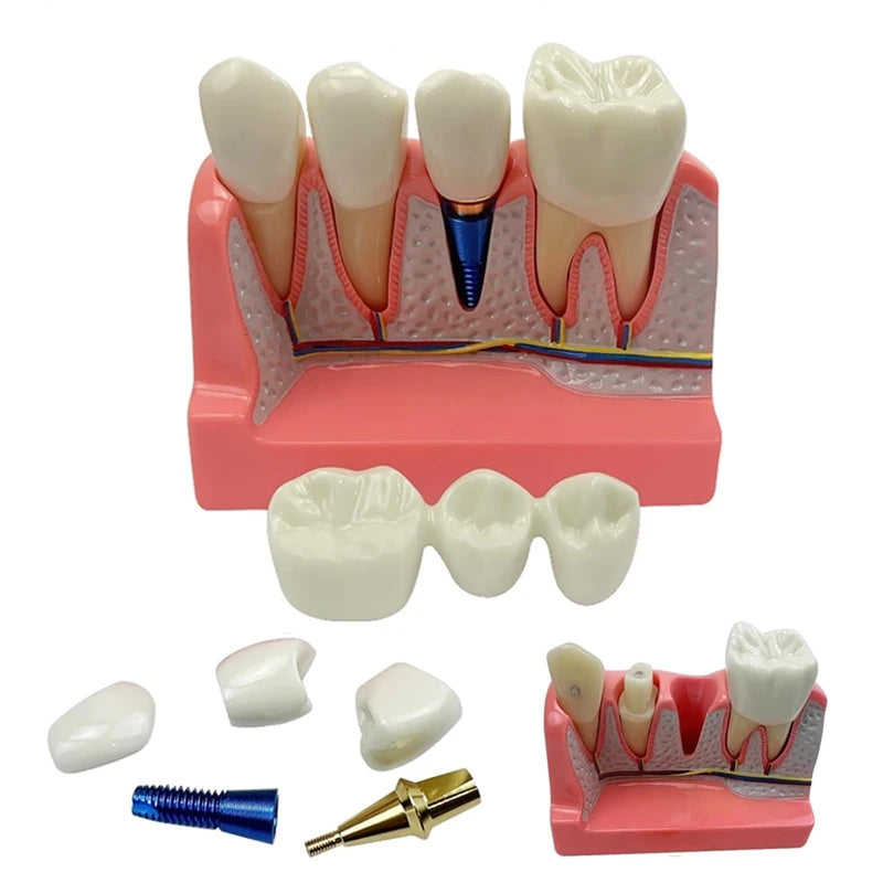 4 Times Dental Implant Model with Removable Crown Bridge Dental Veneers Porcelain Teeth for Stutent Study and Teaching Demonstration