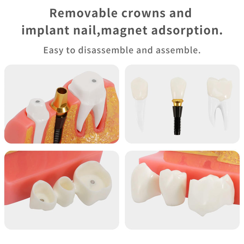 Annhua 4 Times Dental Implant Teeth Model Analysis Crown Bridge Demonstration Model, Dental Teeth Crown Roots Removable for Education, Patients Communication, Learning and Lab
