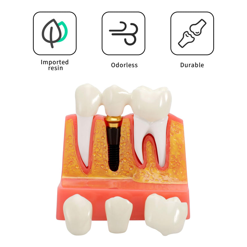 Annhua 4 Times Dental Implant Teeth Model Analysis Crown Bridge Demonstration Model, Dental Teeth Crown Roots Removable for Education, Patients Communication, Learning and Lab