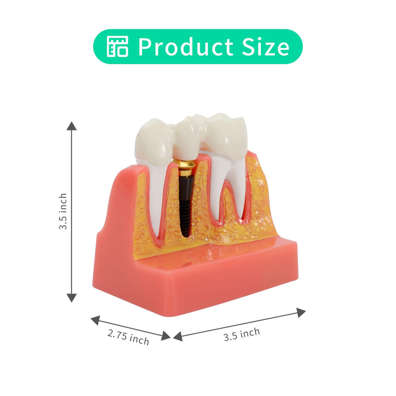 Annhua 4 Times Dental Implant Teeth Model Analysis Crown Bridge Demonstration Model, Dental Teeth Crown Roots Removable for Education, Patients Communication, Learning and Lab