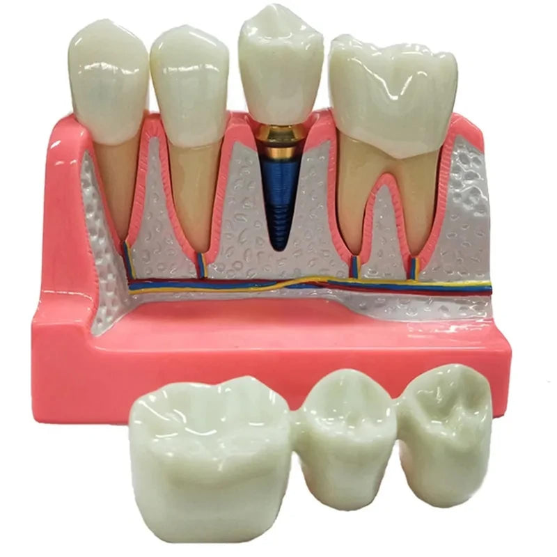 4 Times Dental Implant Model with Removable Crown Bridge Dental Veneers Porcelain Teeth for Stutent Study and Teaching Demonstration