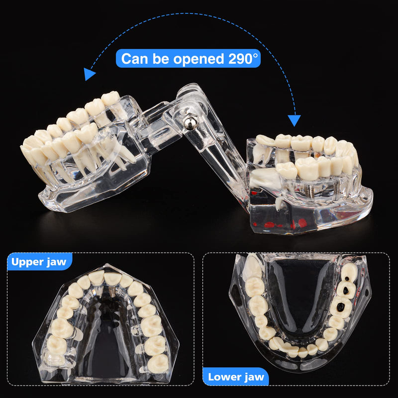 Ultrassist Transparent Disease Teeth Model 2-Pack with Dental Implant Bridge, Dental Model for Patient and Dental Student Education