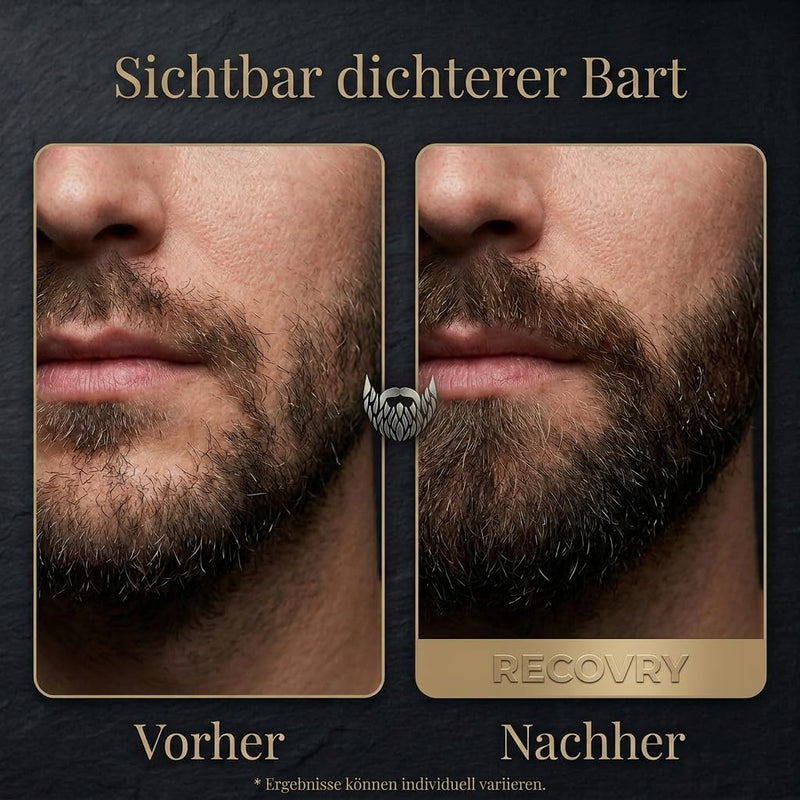 RECOVRY Beard Roller Beard Growth 1 mm - 192 Real Needles for Maximum Beard Growth - Derma Roller with Stainless Steel Needles - Increases Beard Density | Beard Roller (Black, 1 mm)