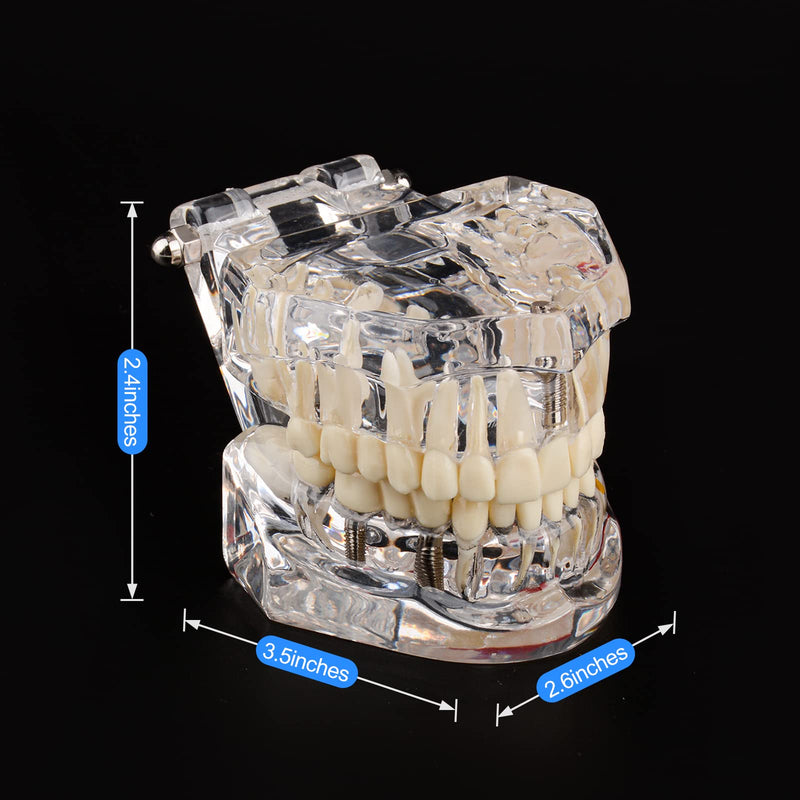 Ultrassist Transparent Disease Teeth Model 2-Pack with Dental Implant Bridge, Dental Model for Patient and Dental Student Education