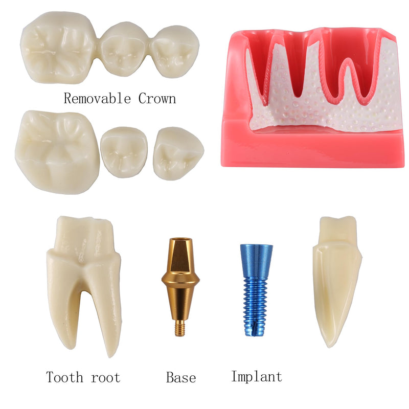4X Dental Implant Demo Model | removable crown, bridge, tooth root, gold-colored base, and blue implant,For Teaching