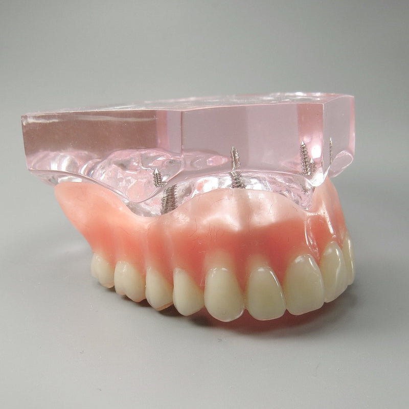 Dental Model Overdenture Upper Teeth 4 Implants Demo for Teaching and Studying