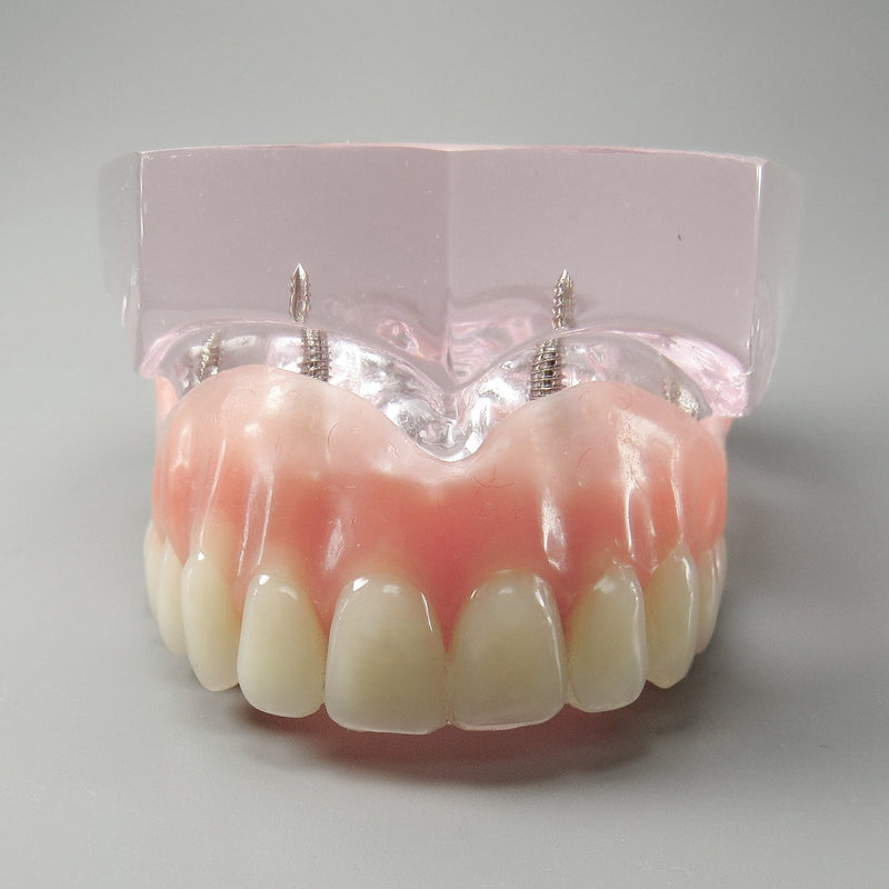 Dental Model Overdenture Upper Teeth 4 Implants Demo for Teaching and Studying