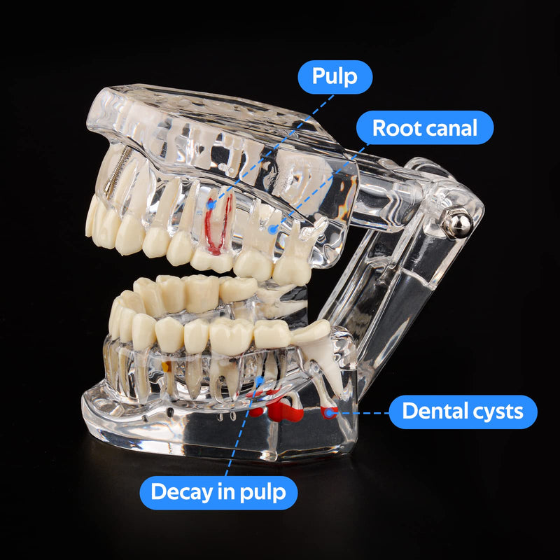 Ultrassist Transparent Disease Teeth Model 2-Pack with Dental Implant Bridge, Dental Model for Patient and Dental Student Education