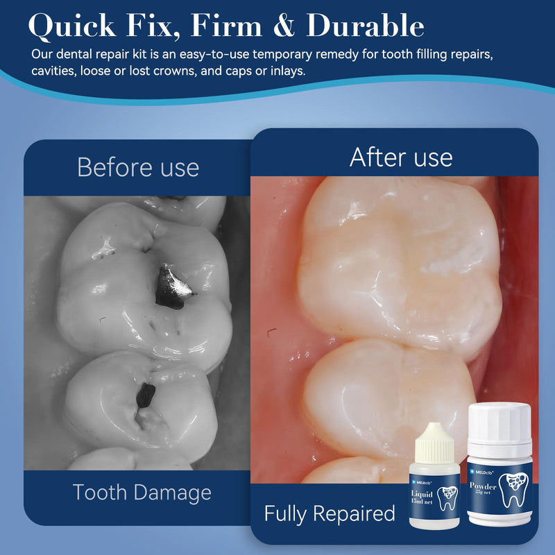 Zinc Oxide Eugenol Dental Care Kit, Tooth Repair Kit, Temporary Tooth Filling Repair Kit, Tooth Filler, Cavity Filler, Dental Cement Glue Adhesive for Crowns, Bridges, Teeth, Home Dental Emergency Fix