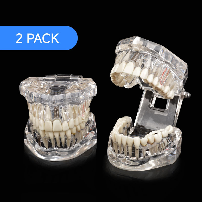 Ultrassist Transparent Disease Teeth Model 2-Pack with Dental Implant Bridge, Dental Model for Patient and Dental Student Education