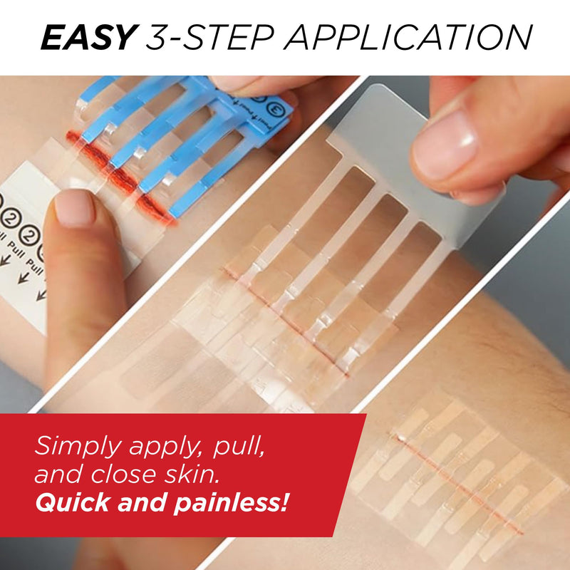 Clozex Emergency Laceration Closures - Repair Wounds Without Stitches, Skin Closure Device for 3 Individual Wounds Or Combine for Total Length of 4 1/4 Inches 3 Closures- 3/4", 1 1/2", 2"
