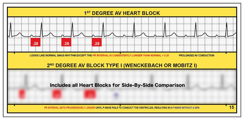 R-CAT for Arrhythmias EKG Pocket Reference Guide – Contains Literally Every EKG Rhythm Known - Great Study Booklet for EKG Interpretation - Cardiac Rhythm Interpretation Made Easy