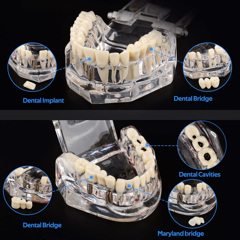 Ultrassist Transparent Disease Teeth Model 2-Pack with Dental Implant Bridge, Dental Model for Patient and Dental Student Education