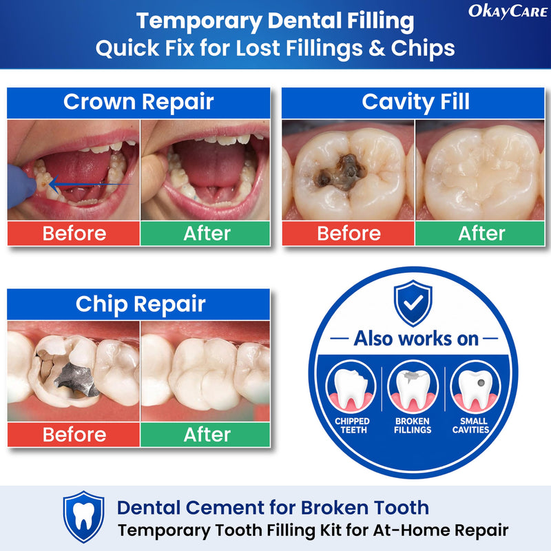 Zinc Oxide Eugenol Dental Cement Kit – Instant Tooth Repair, Cap, Crown & Bridge Filling | Ultra Strong & Pulp-Soothing Formula | Long Lasting - Easy Mix-and-Use Dental Adhesive for DIY, Home & Clinic
