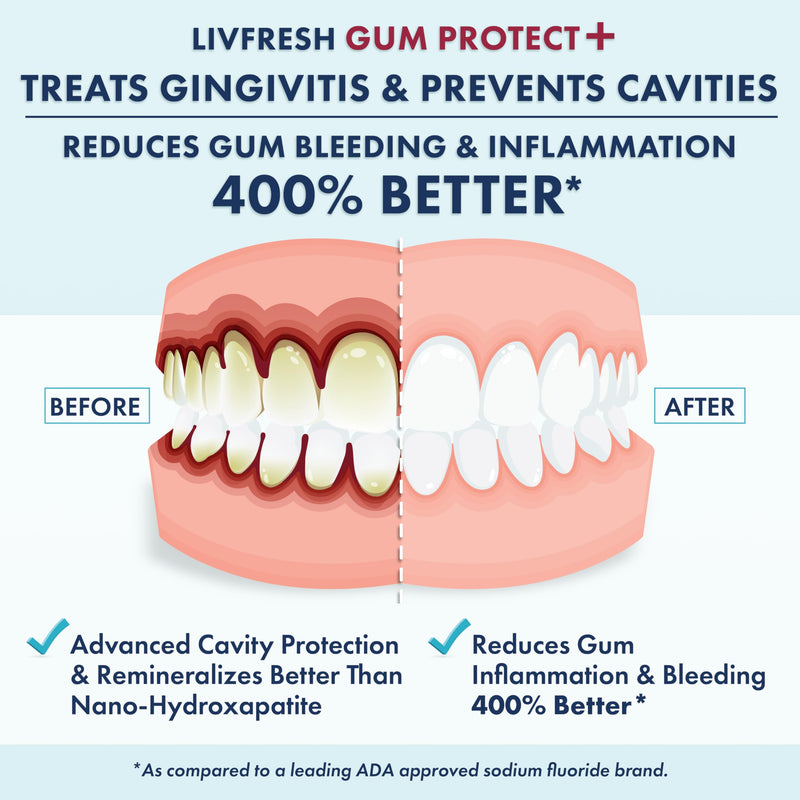 LIVFRESH Gum Protect Toothpaste Gel, Gingivitis Treatment, Reduces Bleeding, Swollen Gums 400% Better, Cavity Protection, Remineralizes Teeth, Whitens Teeth, Stannous Fluoride (1.75 Ounce (Pack of 1) 1.75 Ounce (Pack of 1)