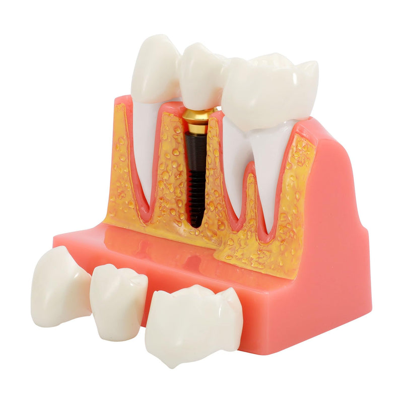 Annhua 4 Times Dental Implant Teeth Model Analysis Crown Bridge Demonstration Model, Dental Teeth Crown Roots Removable for Education, Patients Communication, Learning and Lab