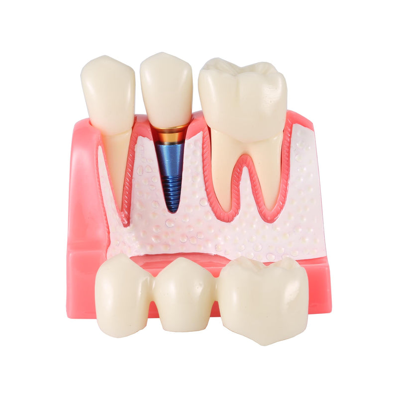 4X Dental Implant Demo Model | removable crown, bridge, tooth root, gold-colored base, and blue implant,For Teaching