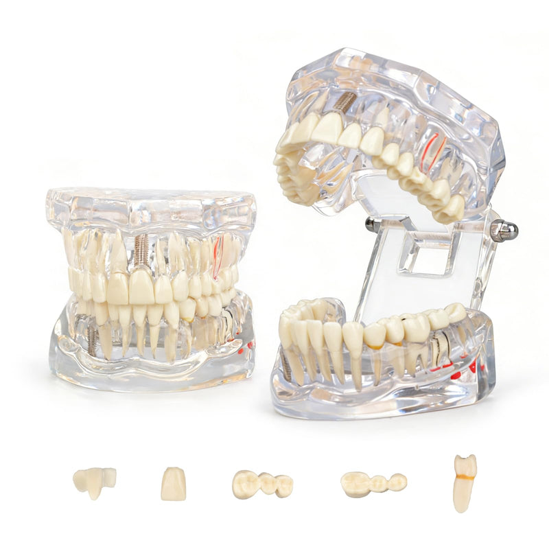 Ultrassist Transparent Disease Teeth Model 2-Pack with Dental Implant Bridge, Dental Model for Patient and Dental Student Education
