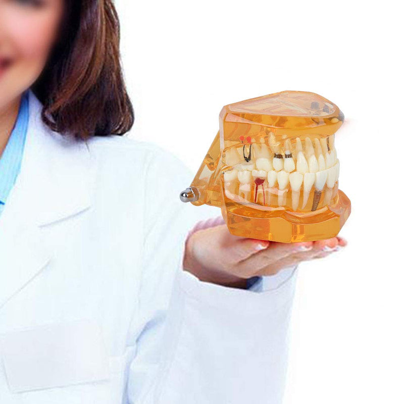  [AUSTRALIA] - Tooth Model For Teaching, Teeth Model of Tooth Degeneration Demonstration Study Orange Dental Model Dentures