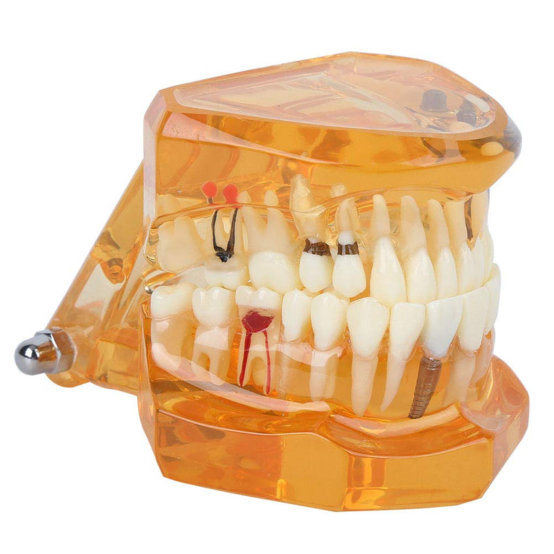  [AUSTRALIA] - Tooth Model For Teaching, Teeth Model of Tooth Degeneration Demonstration Study Orange Dental Model Dentures