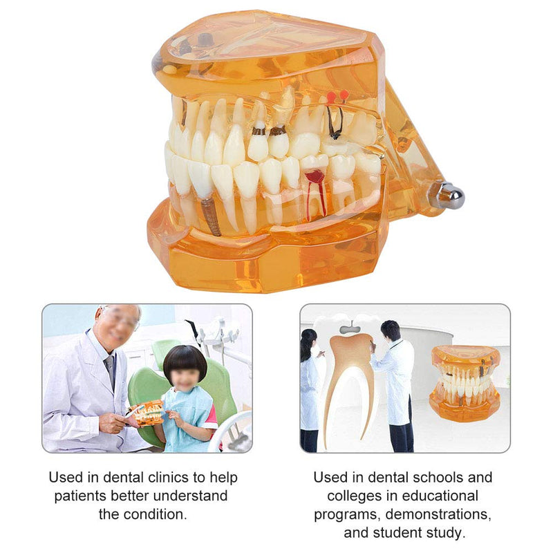  [AUSTRALIA] - Tooth Model For Teaching, Teeth Model of Tooth Degeneration Demonstration Study Orange Dental Model Dentures