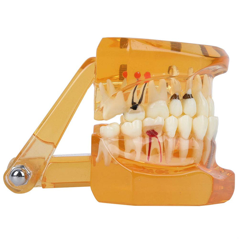  [AUSTRALIA] - Tooth Model For Teaching, Teeth Model of Tooth Degeneration Demonstration Study Orange Dental Model Dentures