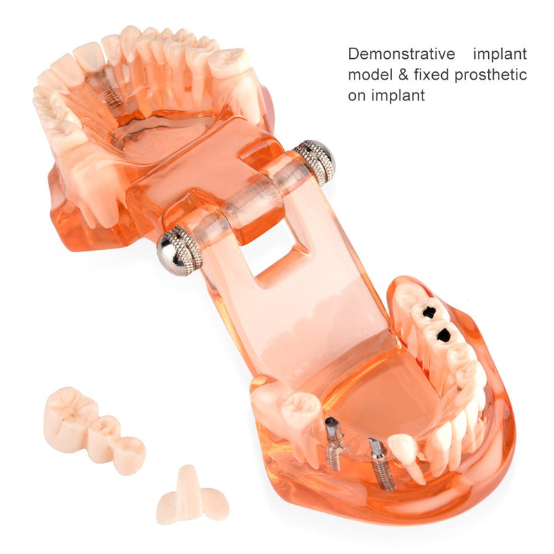  [AUSTRALIA] - Tooth Model For Teaching, Teeth Model of Tooth Degeneration Demonstration Study Orange Dental Model Dentures