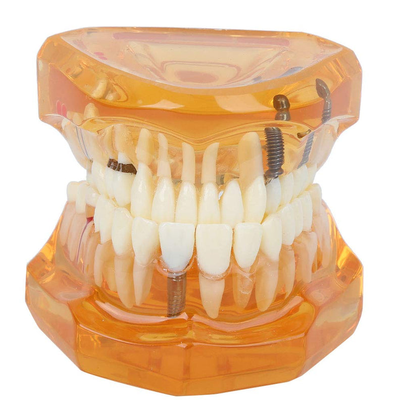  [AUSTRALIA] - Tooth Model For Teaching, Teeth Model of Tooth Degeneration Demonstration Study Orange Dental Model Dentures