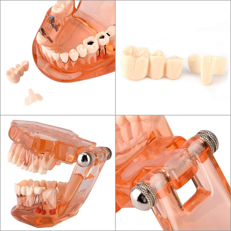  [AUSTRALIA] - Tooth Model For Teaching, Teeth Model of Tooth Degeneration Demonstration Study Orange Dental Model Dentures